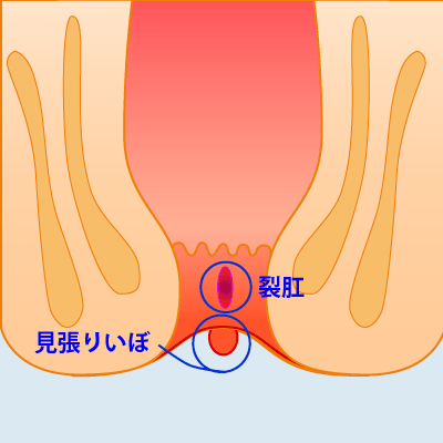 内痔核Ⅱ度