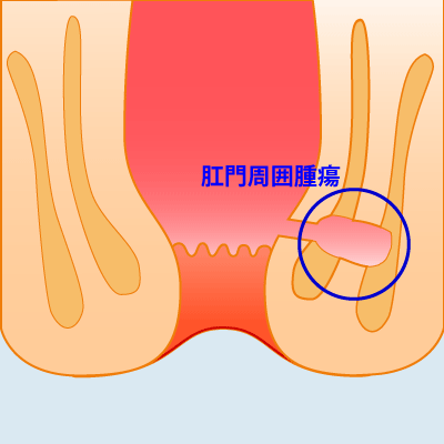 内痔核Ⅲ度