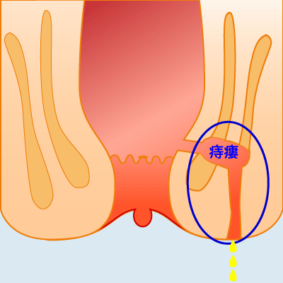 内痔核Ⅳ度