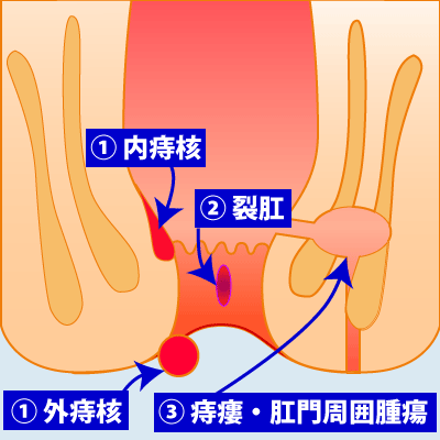 代表的な「痔」疾患