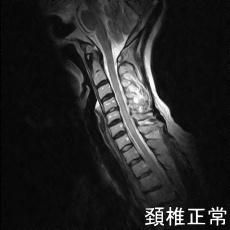 Mri 頚椎